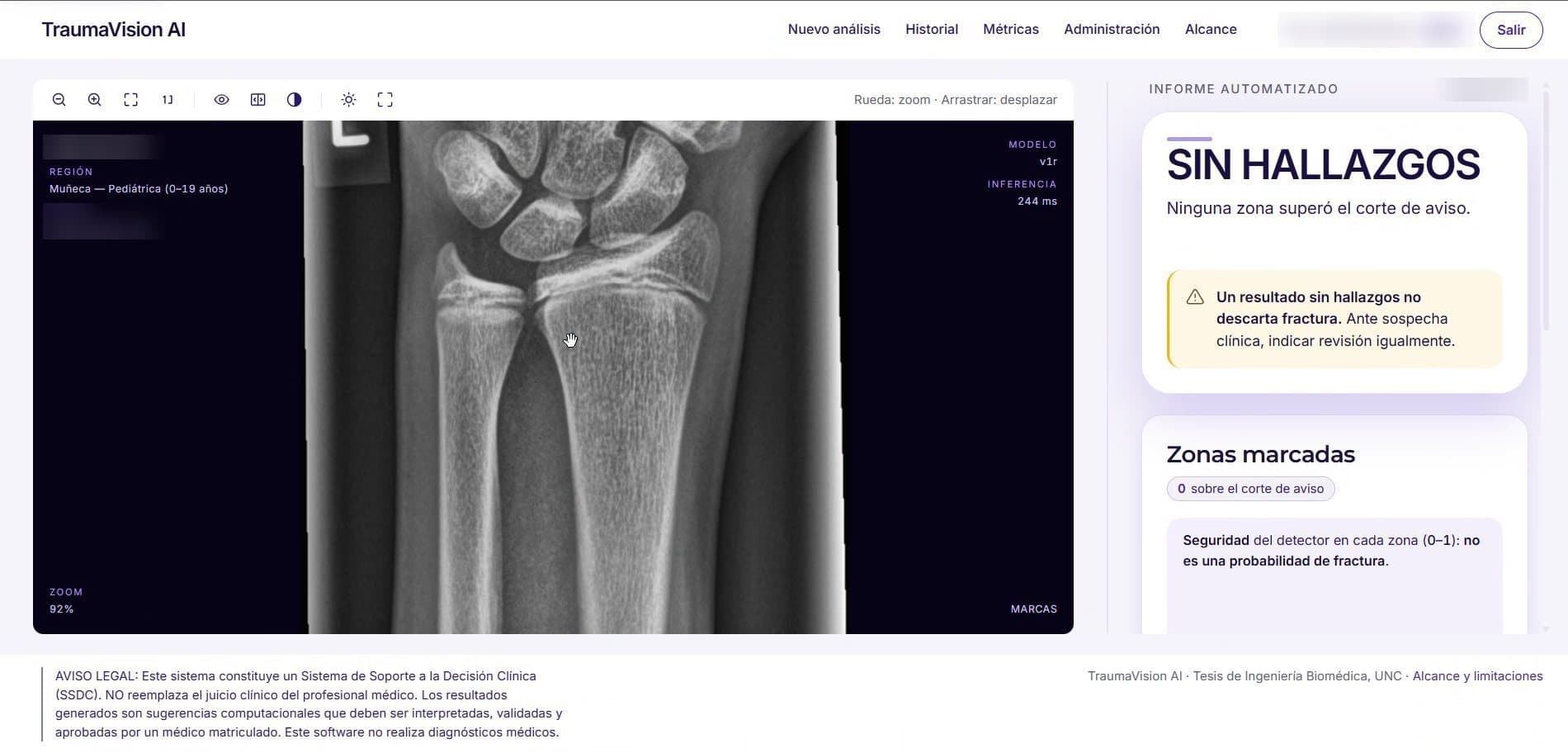 TraumaVision: NO FINDINGS result, with the notice that it does not rule out a fracture